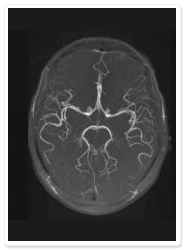 脳血管のMRI画像