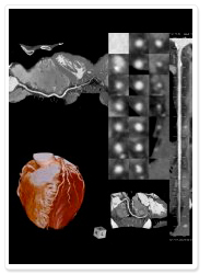 心臓の3D画像解析表示例